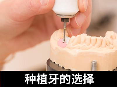 天津50多岁牙齿全口种植牙?天津种植牙医院