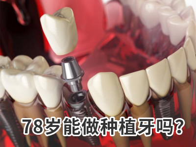 天津老人种植牙半口多少钱种一颗牙好种植牙的费用