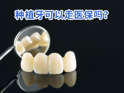 天津半口牙需要几颗种植体种植牙要多少费用