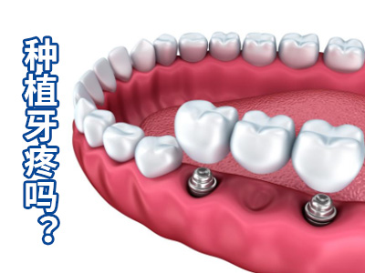 天津半口牙缺失种植3d修复方式要多少价格