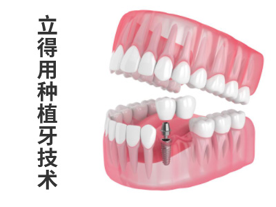 天津all-on-4即刻种植牙修复费用多少钱