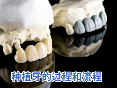 天津4颗门牙种植牙多少钱一颗价格表