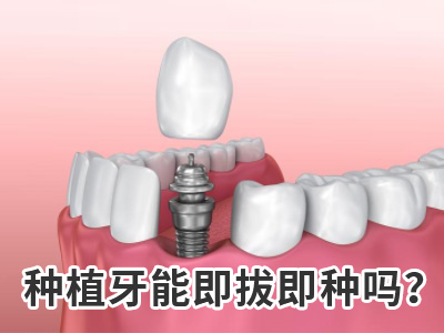 天津全口种植牙纯钛的怎么样需要多少钱