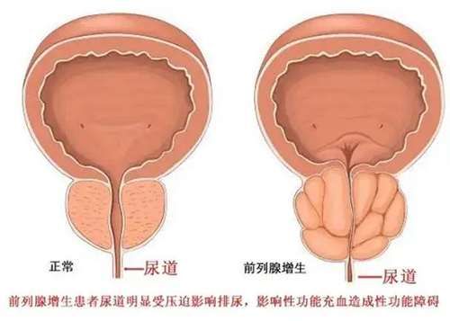 传统电切与激光剜除大对决，前列腺增生患者如何选？