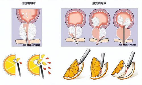 传统电切与激光剜除大对决，前列腺增生患者如何选？