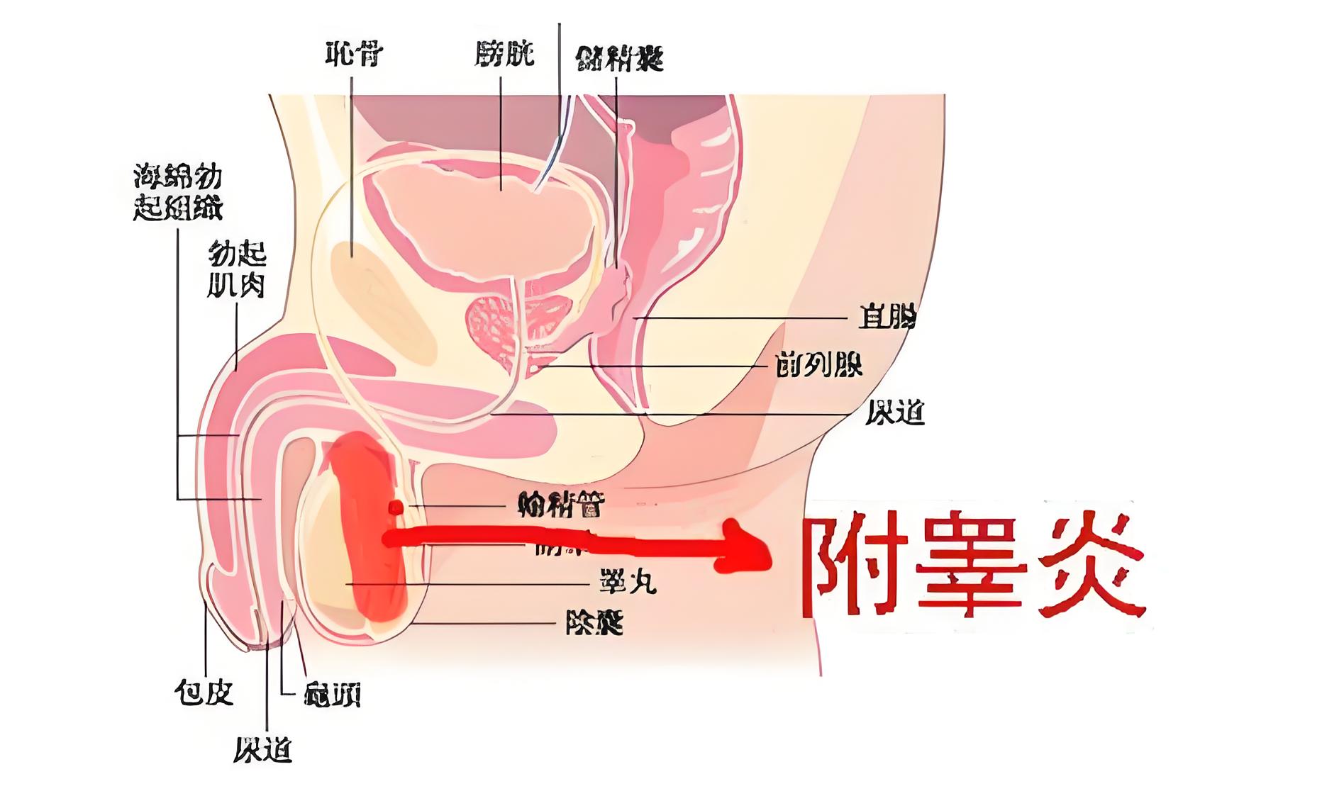 攀枝花男性附睾炎反复，四川泌尿外科医院根治炎症